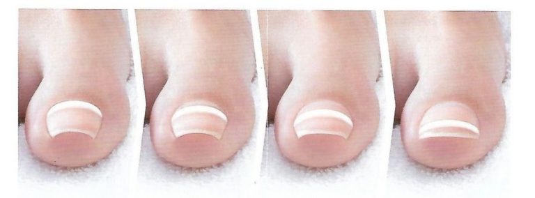 Ingrown Toe Nails – Nevada Foot Institute