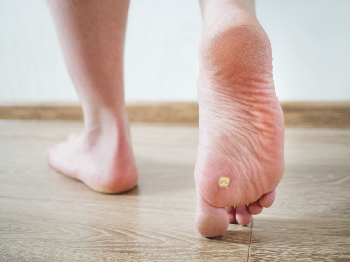 What is a Plantar Wart? - Advanced Foot Care Nurse and ...