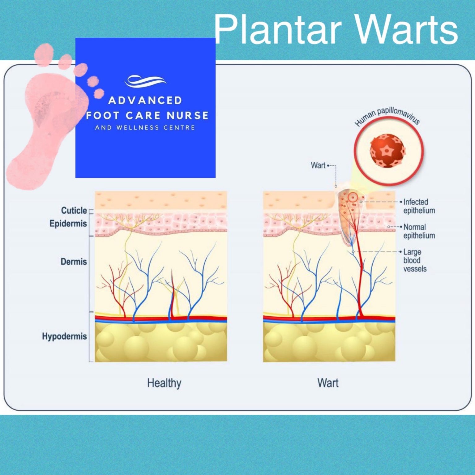 anatomy-of-a-plantar-wart