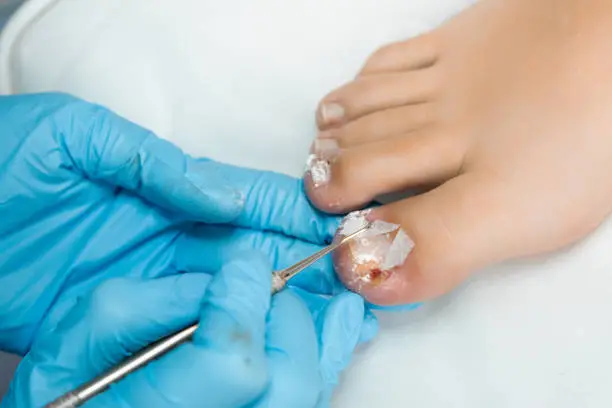 Walking Free: How Our Revolutionary OnyFix Treatment Can End Your Ingrown Nail Suffering